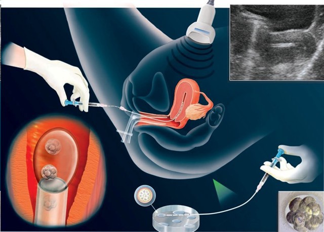 Процесс переноса эмбрионов